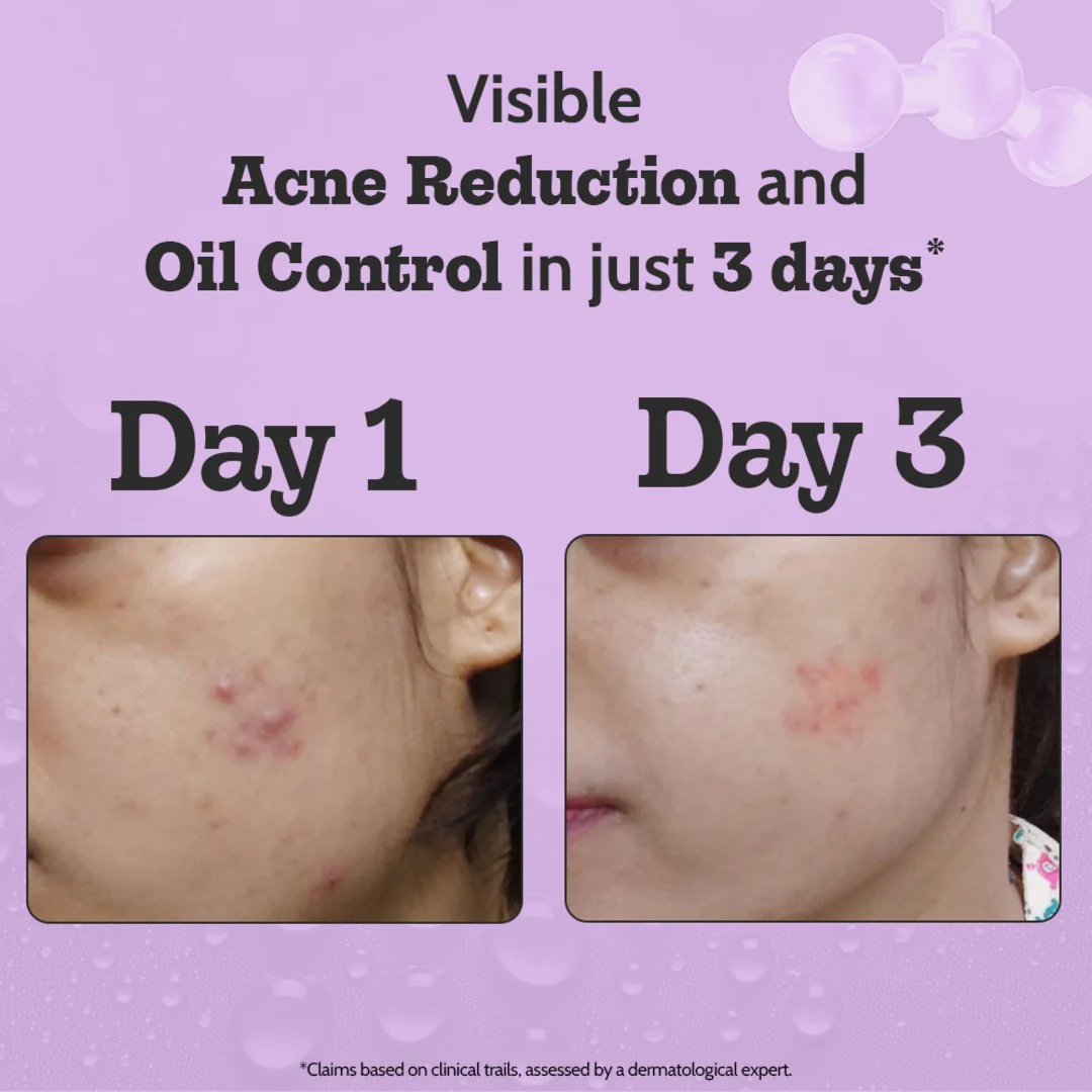 2% Salicylic Acid Face Serum for Acne Control - 30 ml - Image 3